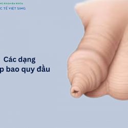 https://chuabenhlaubacninh.com/wp-content/uploads/2024/07/cac-dang-hep-bao-quy-dau-250x250.jpg
