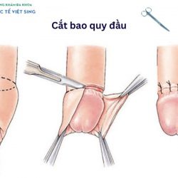 https://chuabenhlaubacninh.com/wp-content/uploads/2024/07/cat-bao-quy-dau-hep-250x250.jpg