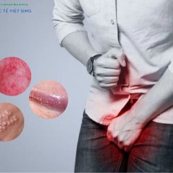 https://chuabenhlaubacninh.com/wp-content/uploads/2024/07/dau-hieu-viem-bao-quy-dau-250x250.jpg