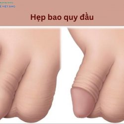 https://chuabenhlaubacninh.com/wp-content/uploads/2024/07/hep-bao-quy-dau-250x250.jpg