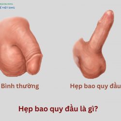 https://chuabenhlaubacninh.com/wp-content/uploads/2024/07/hep-bao-quy-dau-la-gi-250x250.jpg