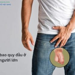 https://chuabenhlaubacninh.com/wp-content/uploads/2024/07/hep-bao-quy-dau-nguoi-lon-2-250x250.jpg