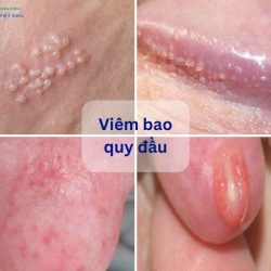 https://chuabenhlaubacninh.com/wp-content/uploads/2024/07/hinh-anh-viem-bao-quy-dau-250x250.jpg