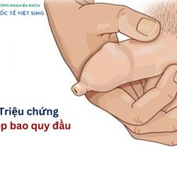 https://chuabenhlaubacninh.com/wp-content/uploads/2024/07/trieu-chung-hep-bao-quy-dau-250x250.jpg