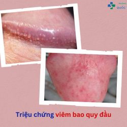 https://chuabenhlaubacninh.com/wp-content/uploads/2024/07/trieu-chung-viem-bao-quy-dau-250x250.jpg