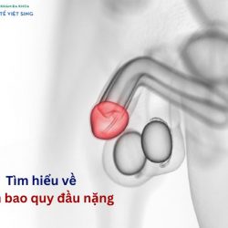 https://chuabenhlaubacninh.com/wp-content/uploads/2024/07/viem-bao-quy-dau-nang-250x250.jpg